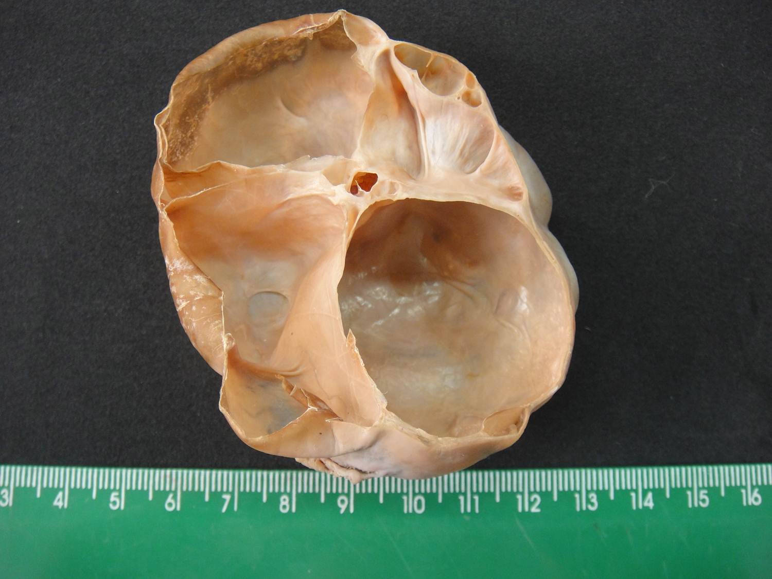 neoplasia benigna 19-cistoadenoma de ovário