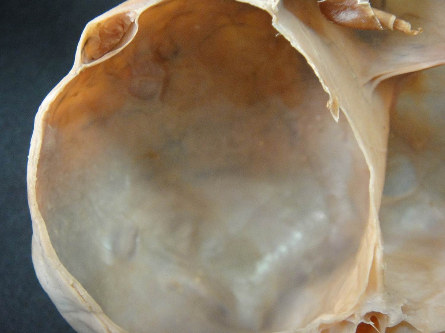 neoplasia benigna 21-cistoadenoma de ovário
