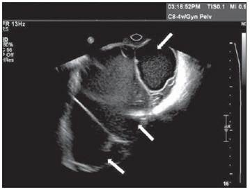 neoplasia benigna 23-cistoadenoma de ovário