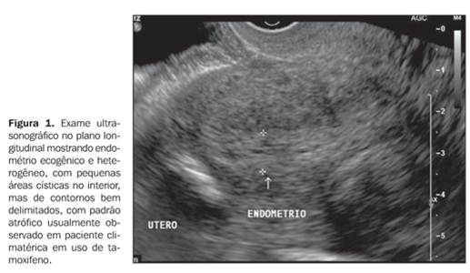 adaptação celular 31-atrofia uterina