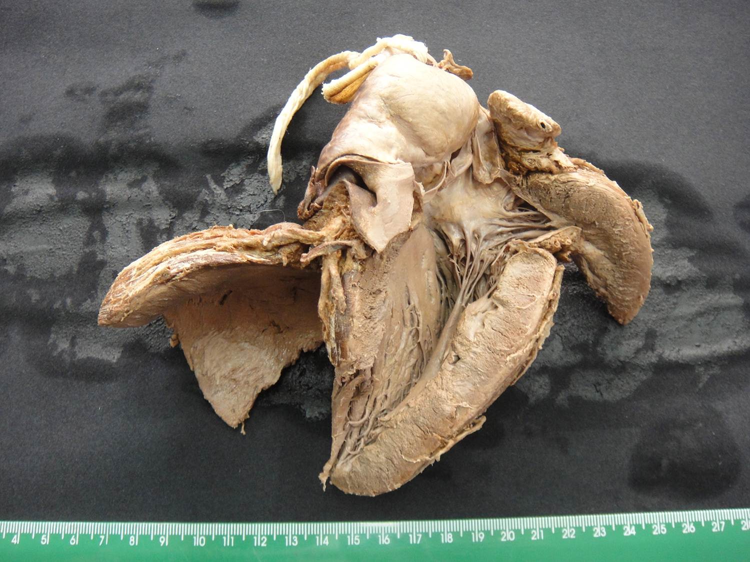 adaptação celular 08-hipertrofia ve, insuf. aortica, aterosclerose, infarto septal antigo