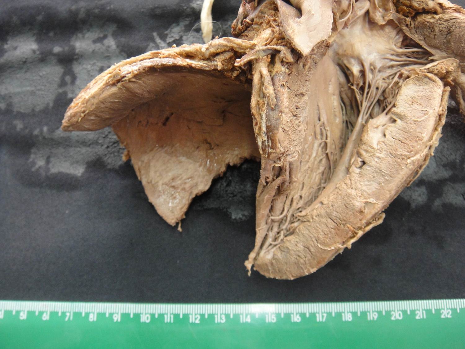 adaptação celular 09-hipertrofia ve, insuf. aortica, aterosclerose, infarto septal antigo