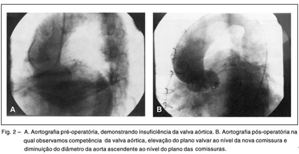adaptação celular 11-hipertrofia ve, insuf. aortica, aterosclerose, infarto septal antigo