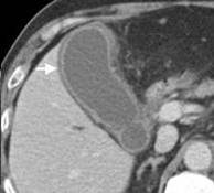 inflamação aguda 13-colecistite aguda