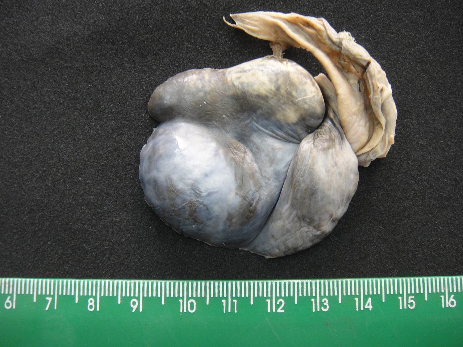 morte celular 11-infarto testicular