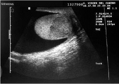 morte celular 13-infarto testicular