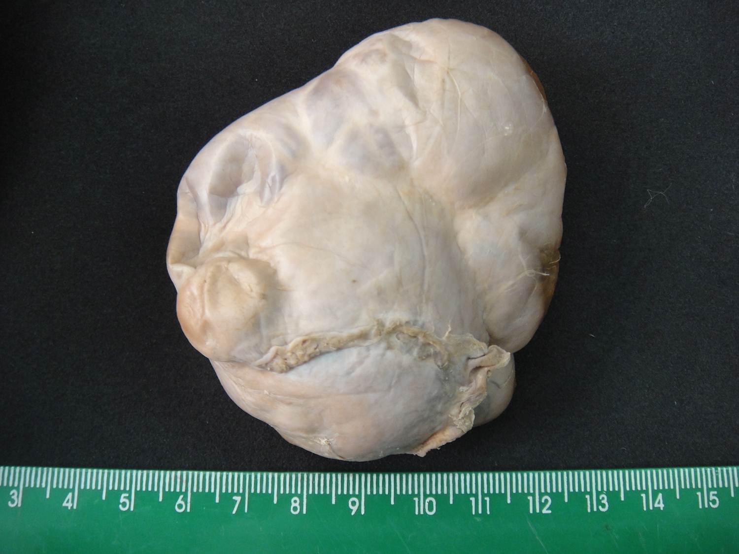 neoplasia benigna 20-cistoadenoma de ovário