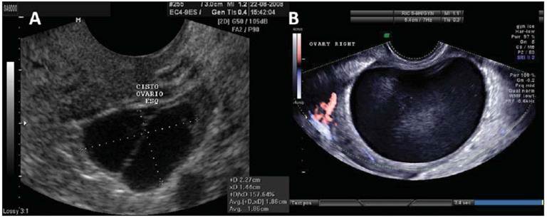 neoplasia benigna 22-cistoadenoma de ovário