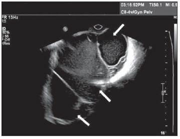 32- Ooforectomia- Remoção dos Ovários por Tumor (Adenoma Mucisono