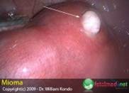 neoplasia benigna 13-leiomioma em parturição