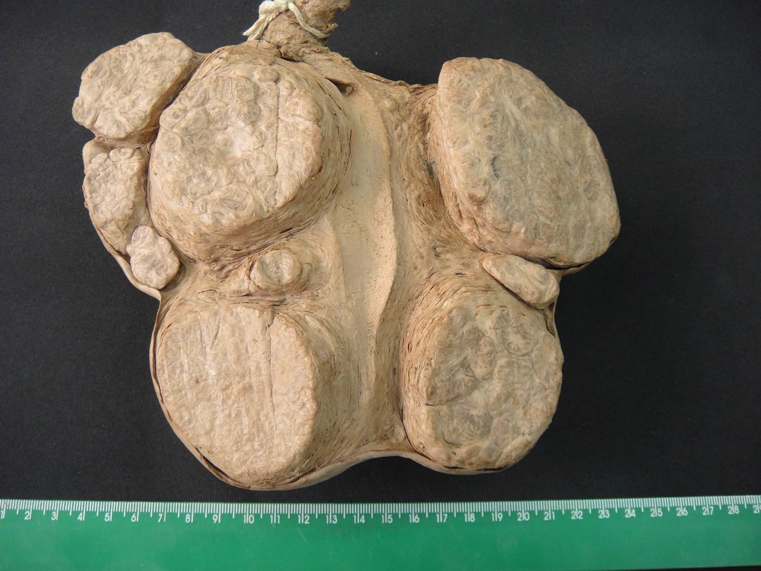 neoplasia benigna 04-leiomioma