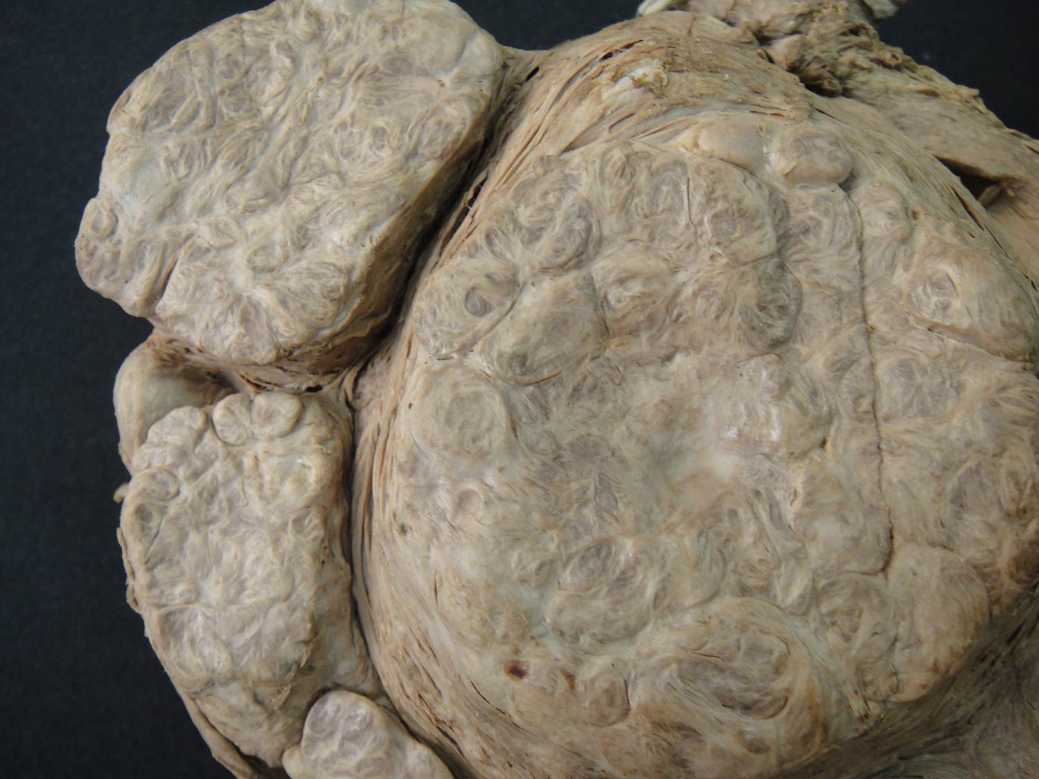 neoplasia benigna 06-leiomioma