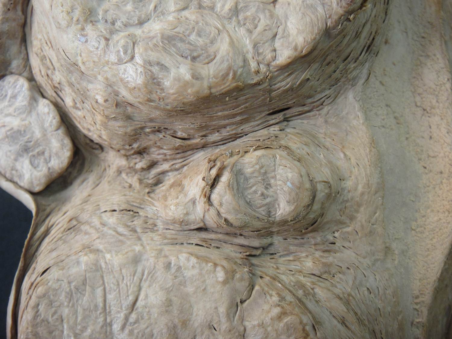neoplasia benigna 08-leiomioma