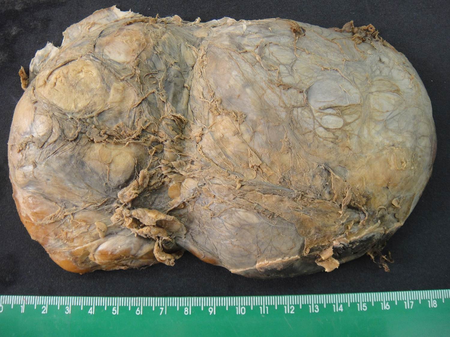neoplasia benigna 02-lipoma