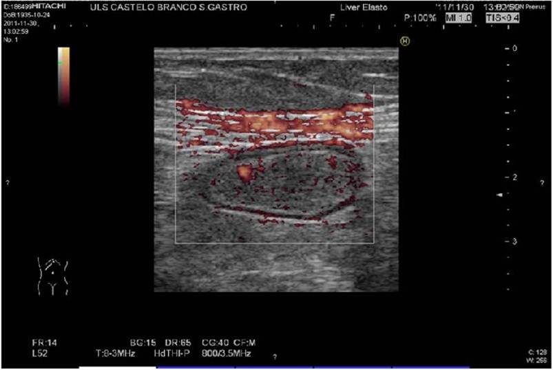neoplasia benigna 03-lipoma