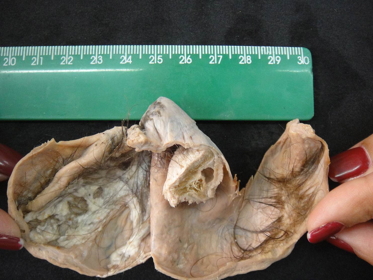 neoplasia benigna 14-teratoma cístico