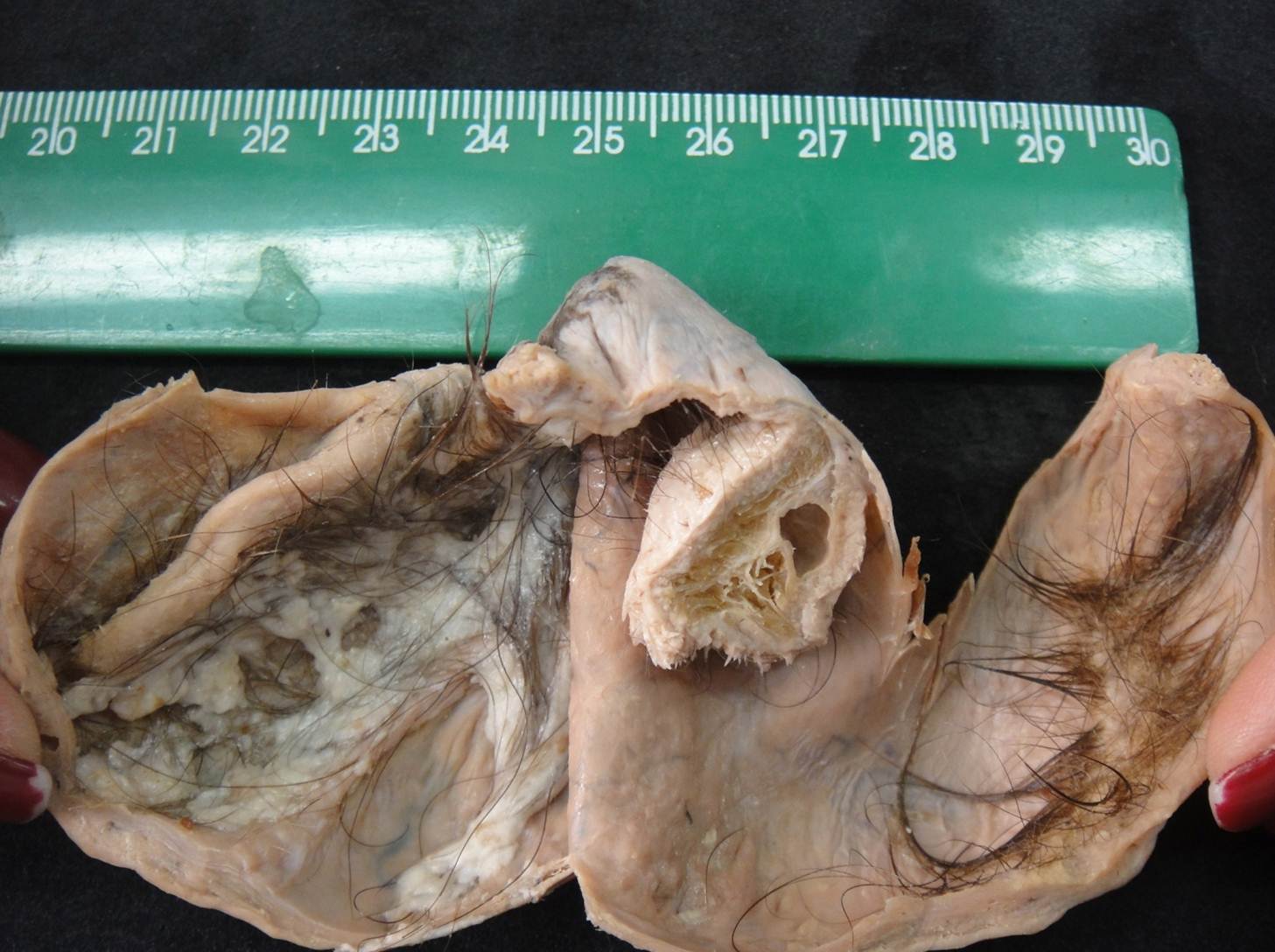 neoplasia benigna 15-teratoma cístico
