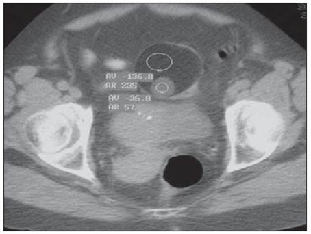 neoplasia benigna 17-teratoma cístico