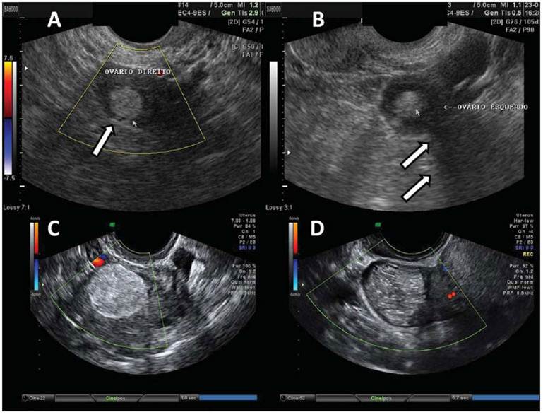 neoplasia benigna 18-teratoma cístico